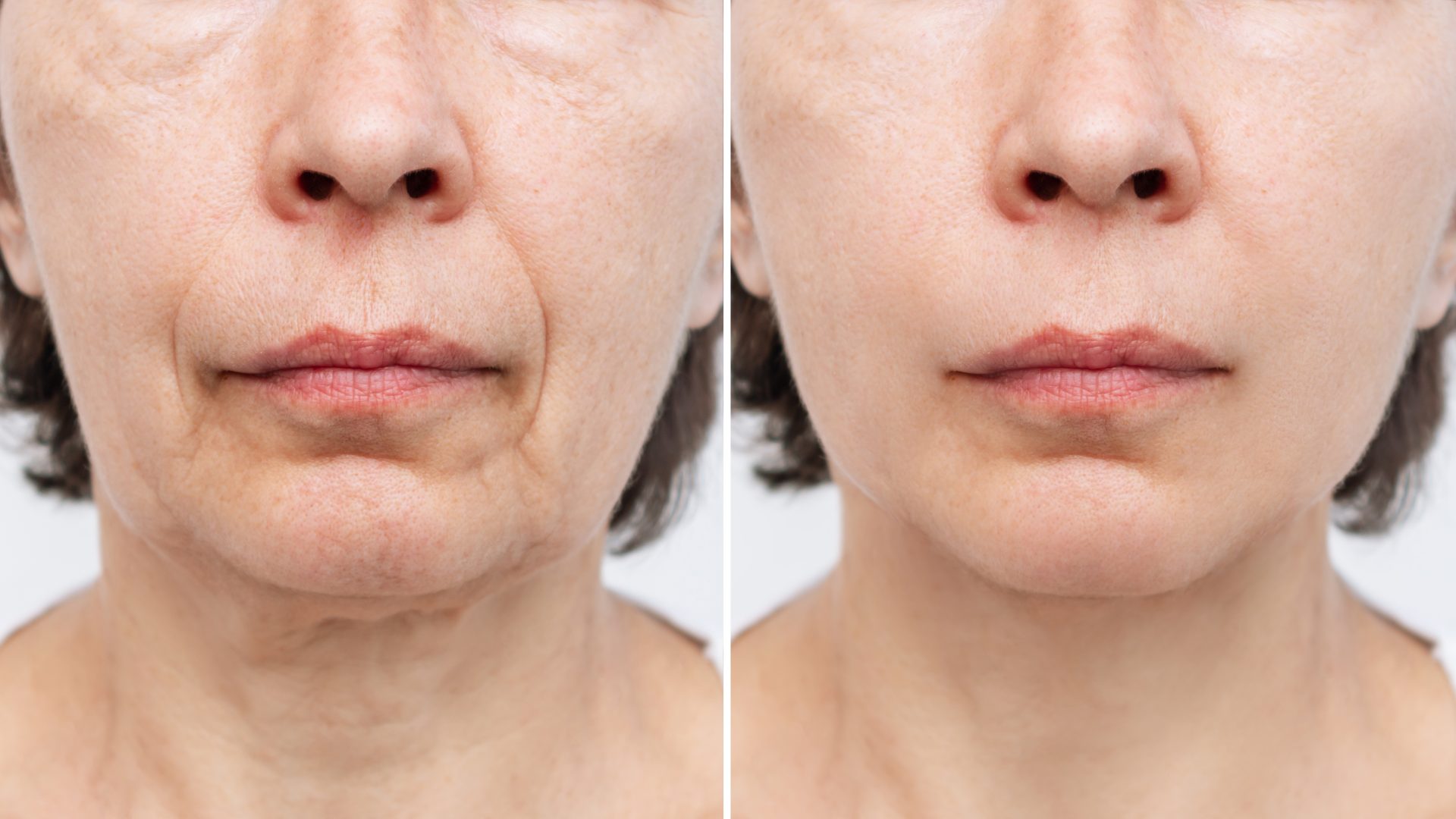 Ästhetik mit Facelifting ohne OP in Unterhaching und Detox-Infusion